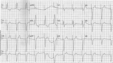 Pacemaker Syndrome. Retrogradely conducted P waves