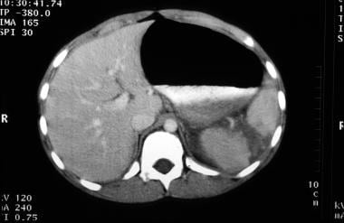 Computed tomography (CT) image of grade IV splenic
