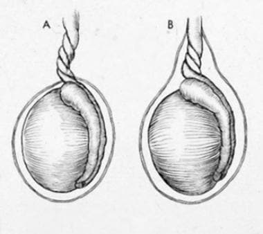 testicular torsion intravaginal