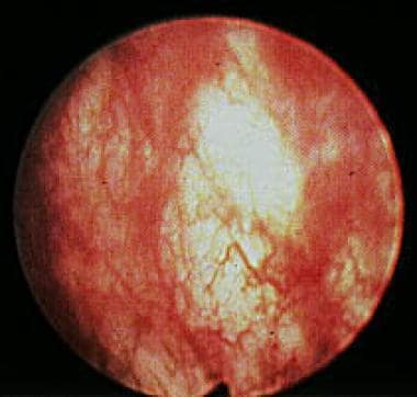 Cystoscopic view of a radiated bladder showing are