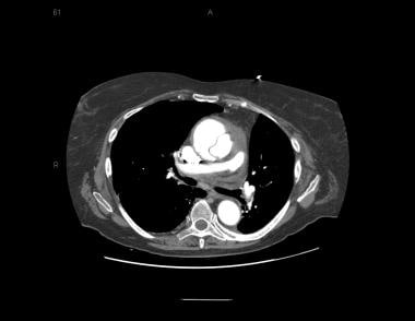 Patient with an ascending type A aortic dissection