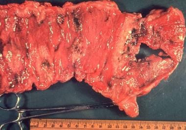 Gross pathology of intestinal ulcers due to amebia