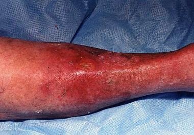Severe cellulitis of the leg in a woman aged 80 ye