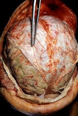 Pneumococcal meningitis in a patient with alcoholi