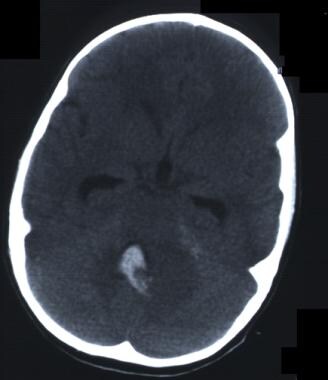 CT scan without contrast. Fourth ventricle ependym