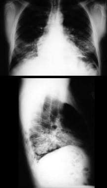 Bacterial pneumonia. Radiographic images in a pati