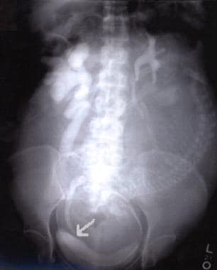 The arrow in this intravenous pyelogram of a gravi