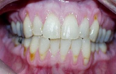Severe periodontal disease. Loss of the gingival t