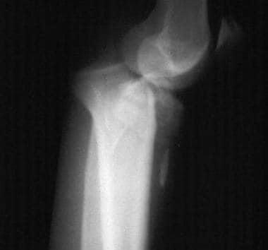 Posterior knee dislocation. 