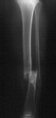 Radiograph demonstrating a displaced tibial shaft 
