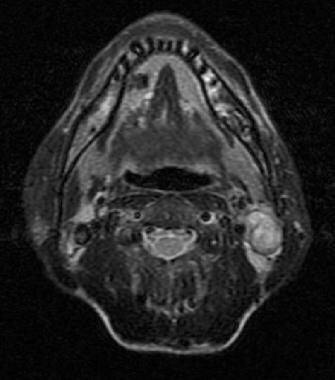Axial T2-weighted image shows a left-sided cervica