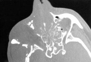 Axial CT scan demonstrates a comminuted nasoorbito