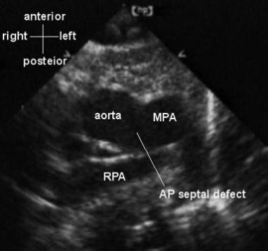 Echocardiographic image of a 1-month-old infant wi