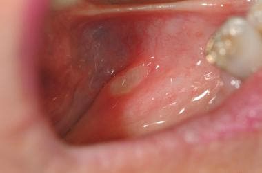 Recurrent aphthae in floor of mouth, showing ovoid