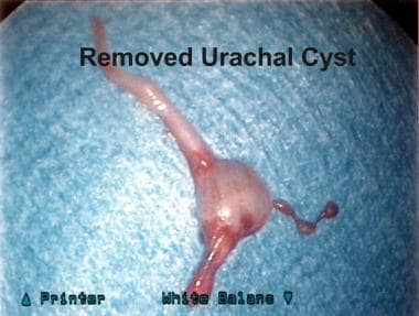 Photograph of laparoscopically removed urachal cys