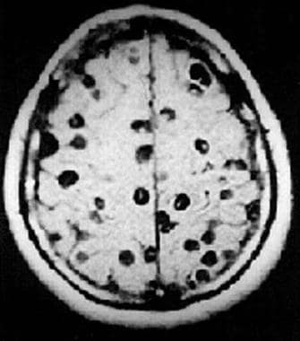 MRI of multiple cysts. Image courtesy of the Cente