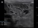 Pediatric Pyloric Stenosis