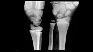 Growth plate (physeal) fractures. Minimally displa