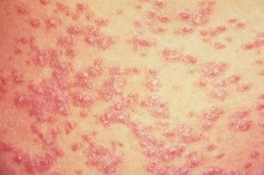dyshidrotic eczema pattanásos vörös foltok a bőrön