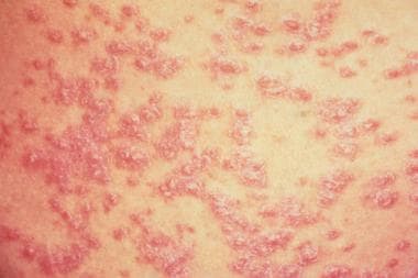 guttate psoriasis strep pikkelysömör kezelése jerusalemben