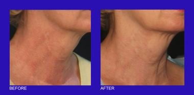 Poikiloderma on the neck before and after two 585-
