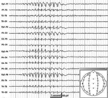 EEG of a typical absence seizure with 3-Hz spike-a