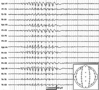 eeg for absence seizures