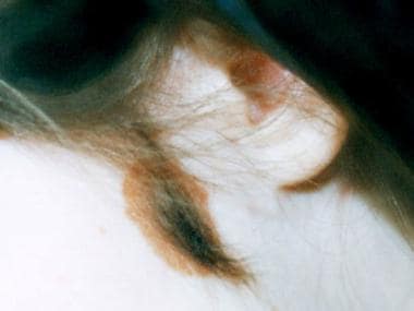 congenital nevus scalp