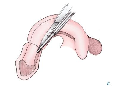 This illustration shows removal of a penile tourni