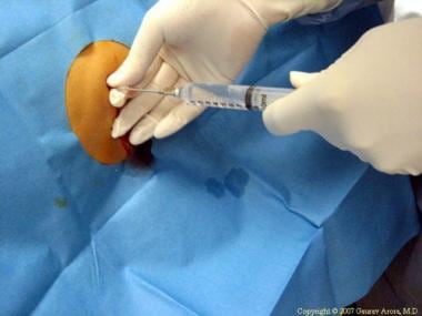 Percutaneous liver biopsy. Biopsy needle inside li