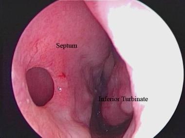 Endoscopic view of a septal perforation from the l