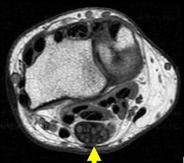 Axial T1-weighted image of 40-year-old woman who e