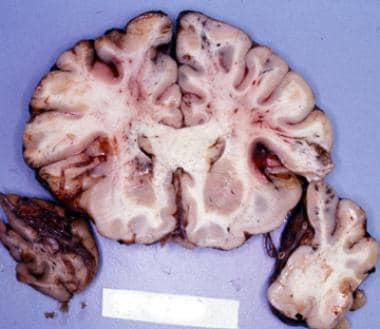 Coronal section of the brain shows streak hemorrha