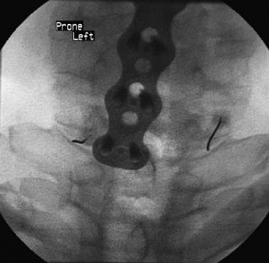 Cervical facet injection at C7-T1 shows the needle