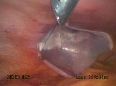 Laparoscopic splenectomy. Pulling spleen up to 12-