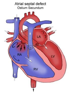 Anatomy of atrial septal defect. This figure shows