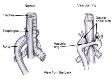 Double aortic arch causing vascular ring. 