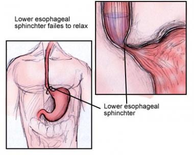 Nonrelaxing lower esophageal sphincter. 