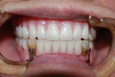 Maxillary complete acrylic denture and mandibular 