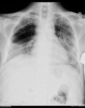 Coccidioidomycosis Imaging: Overview, Radiography, CT Scan