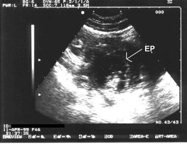 Pregnancy diagnosis. Sonogram showing a complex ma