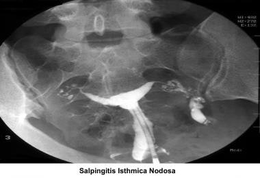 Infertility. Salpingitis isthmica nodosa. Image co