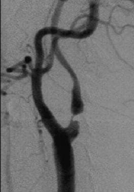 Digital subtraction angiogram performed in the sam