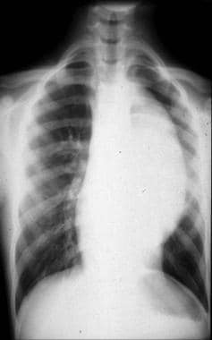 Frontal chest radiograph shows a large left parasp