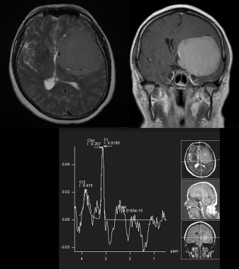 MRI with the following sequences: axial T2, corona