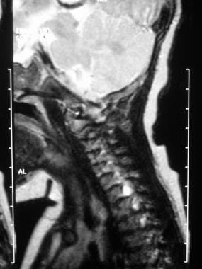 Birth trauma. Sagittal image of the brachial plexu