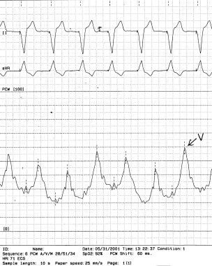 Imaging in Mitral Regurgitation: Overview, Radiography, Computed Tomography