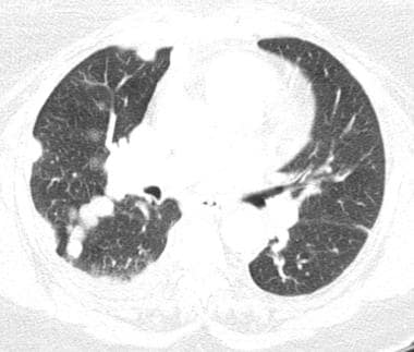 Axial CT scan of a patient with thyroid cancer sho