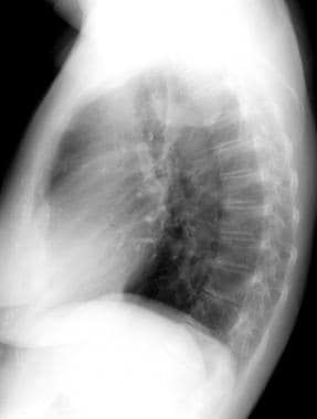 Lateral chest radiograph in a 70-year-old woman wh