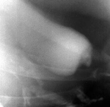 Oral cholecystogram shows focal fundal thickening 